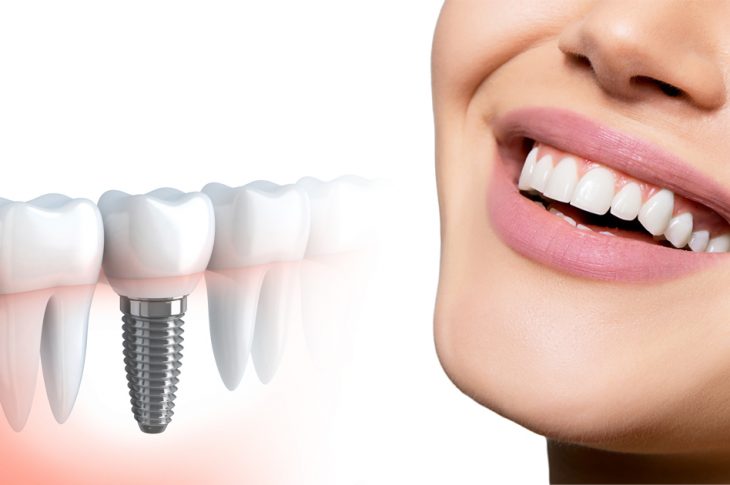 Implants dentaires pas chers comment choisir le bon dentiste